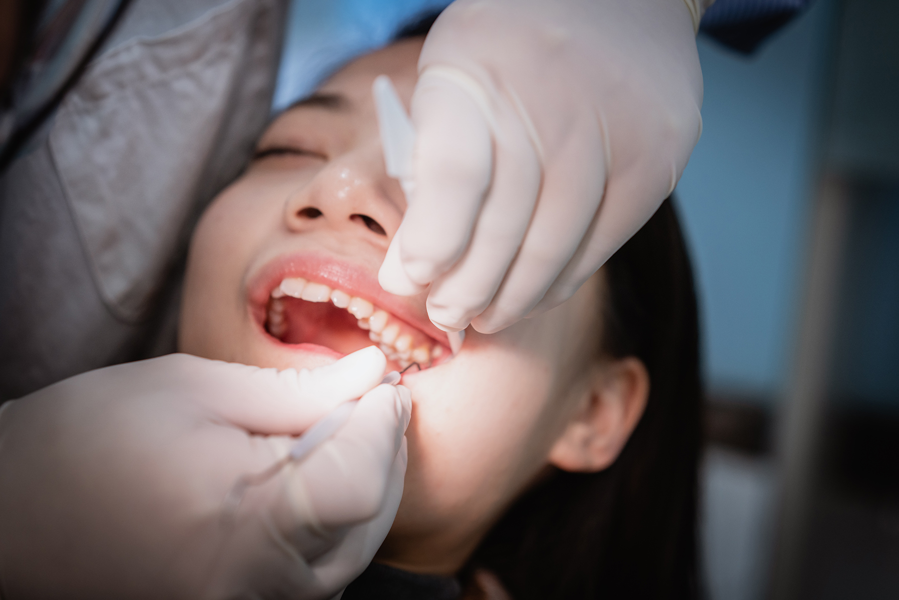 Dental extractions procedure in Vero Beach, FL