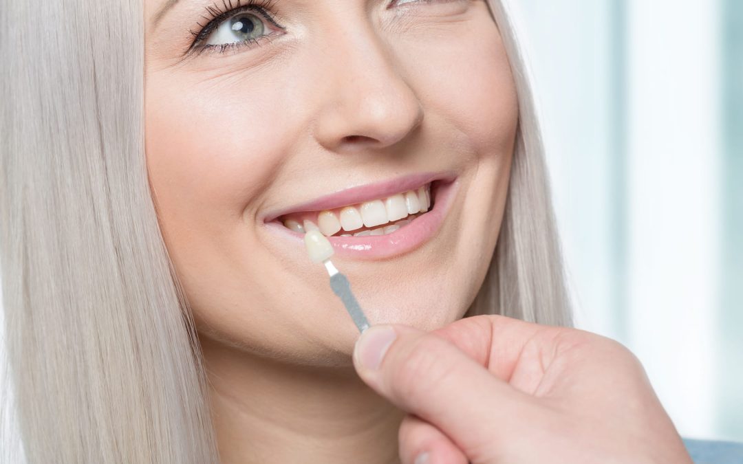 Are Dental Veneers Right For My Smile?